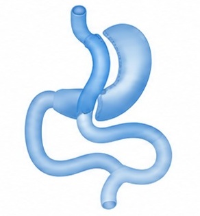 Mini Gastric Bypass