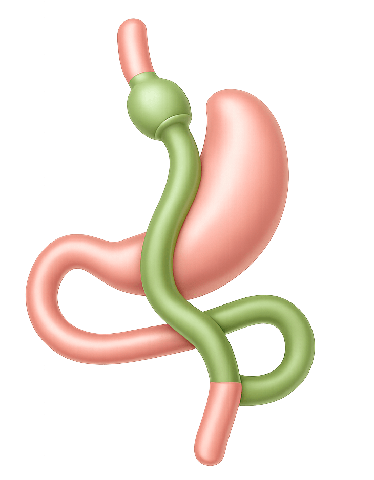 Gastric Bypass