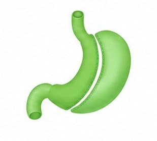 Sleeve Gastrectomy