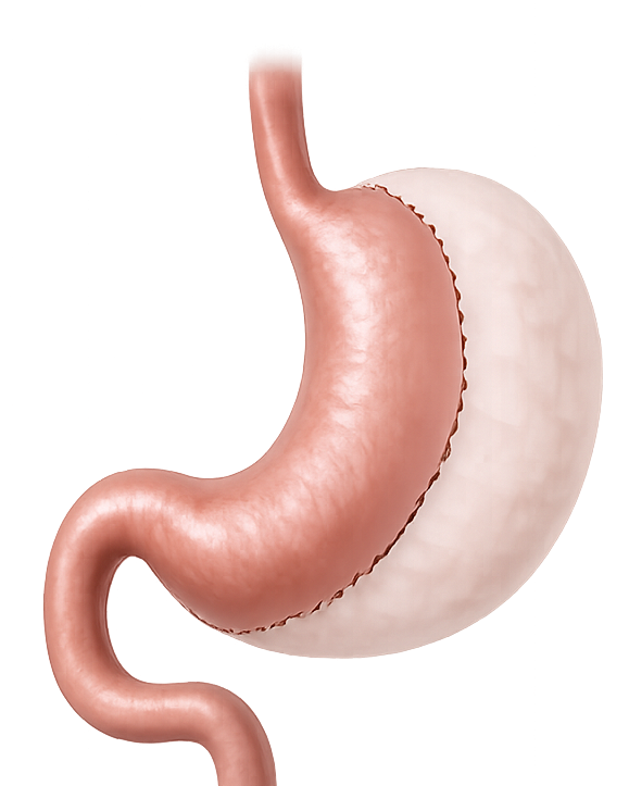 Remove Stomach Portion
